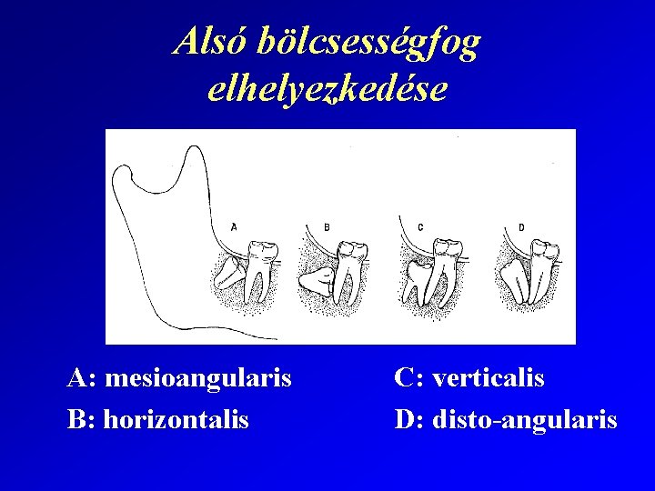 Alsó bölcsességfog elhelyezkedése A: mesioangularis B: horizontalis C: verticalis D: disto-angularis 