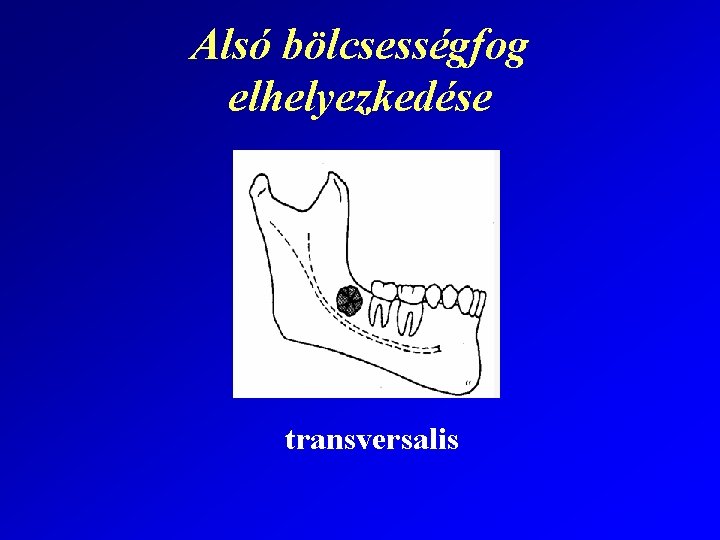 Alsó bölcsességfog elhelyezkedése transversalis 