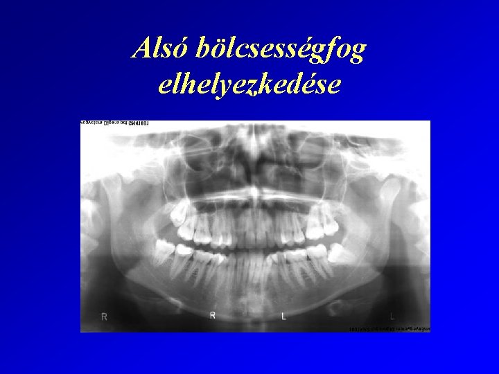 Alsó bölcsességfog elhelyezkedése 