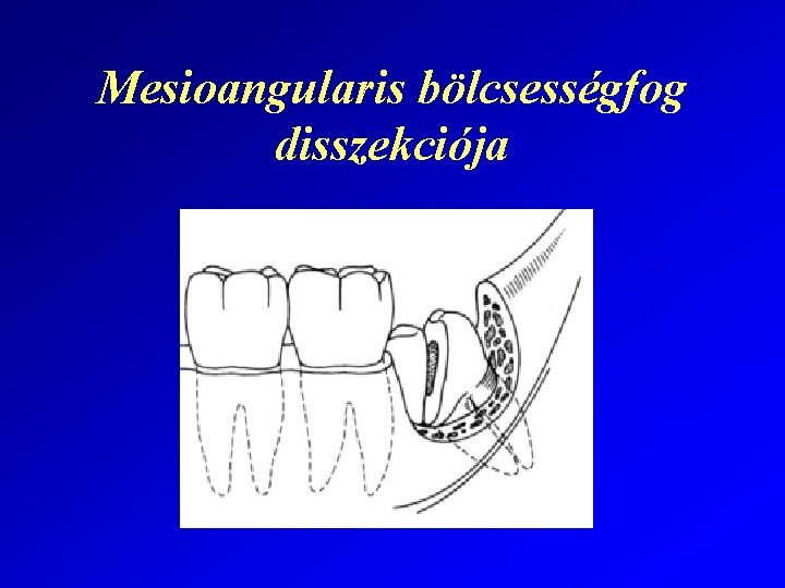 Mesioangularis bölcsességfog disszekciója 