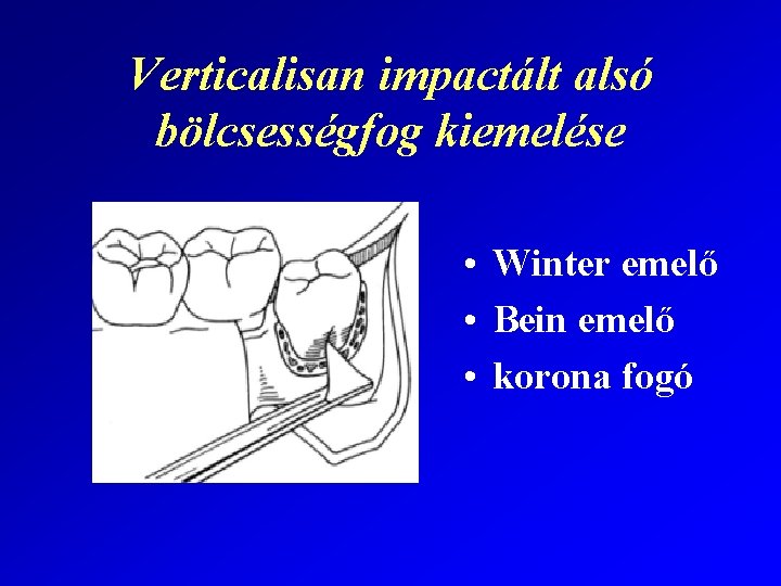 Verticalisan impactált alsó bölcsességfog kiemelése • Winter emelő • Bein emelő • korona fogó