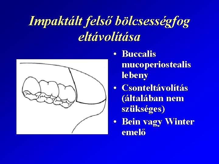 Impaktált felső bölcsességfog eltávolítása • Buccalis mucoperiostealis lebeny • Csonteltávolítás (általában nem szükséges) •