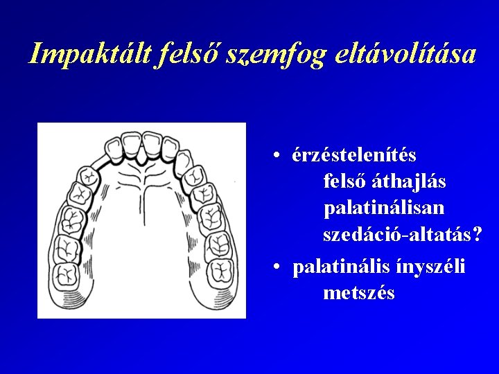 Impaktált felső szemfog eltávolítása • érzéstelenítés felső áthajlás palatinálisan szedáció-altatás? • palatinális ínyszéli metszés