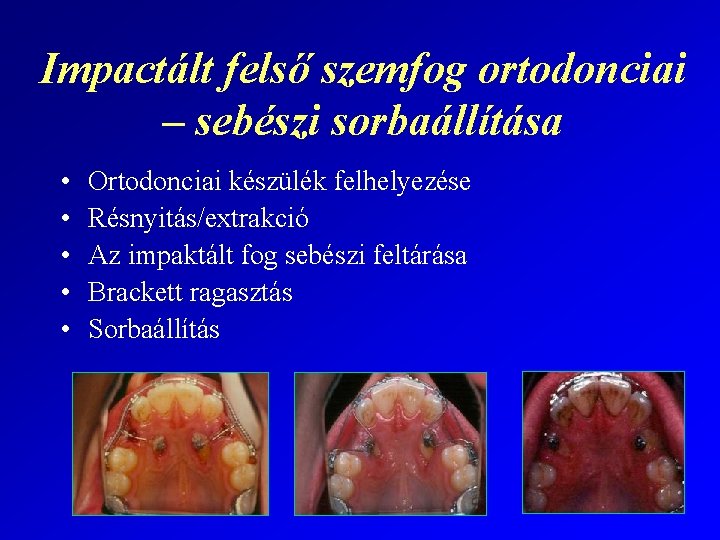 Impactált felső szemfog ortodonciai – sebészi sorbaállítása • • • Ortodonciai készülék felhelyezése Résnyitás/extrakció