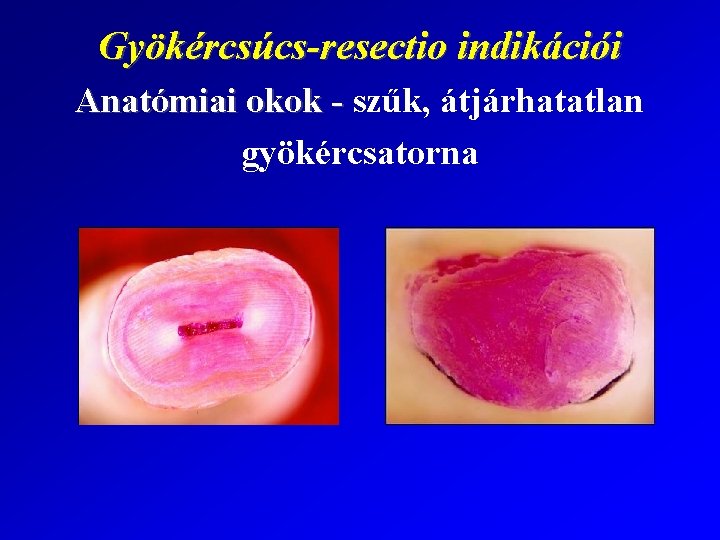 Gyökércsúcs-resectio indikációi Anatómiai okok - szűk, átjárhatatlan gyökércsatorna 