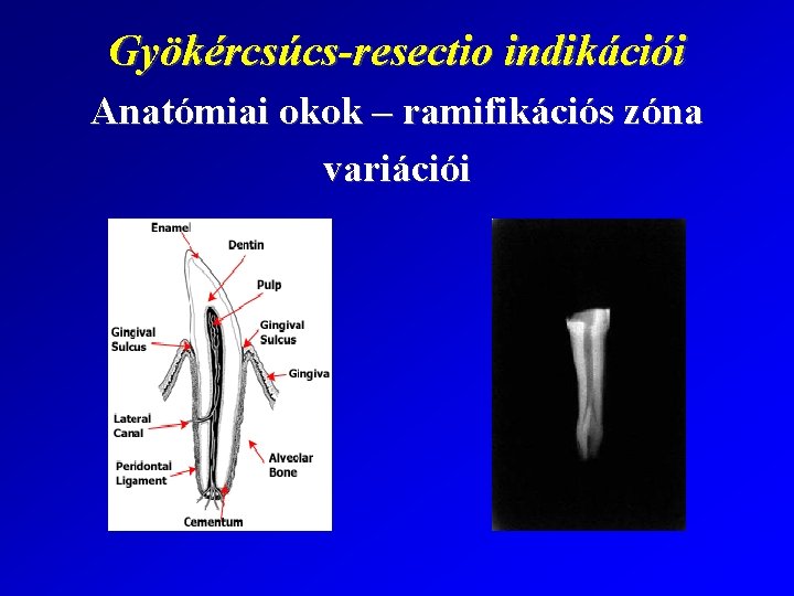 Gyökércsúcs-resectio indikációi Anatómiai okok – ramifikációs zóna variációi 