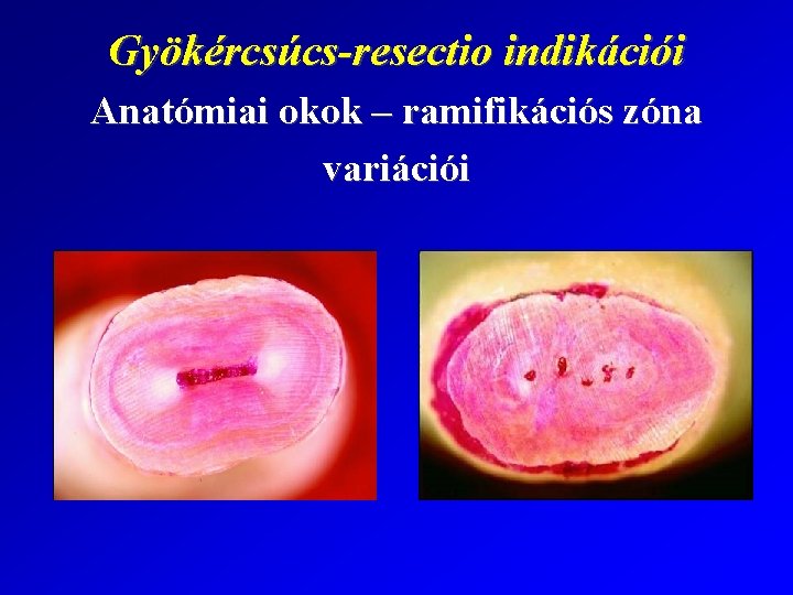 Gyökércsúcs-resectio indikációi Anatómiai okok – ramifikációs zóna variációi 