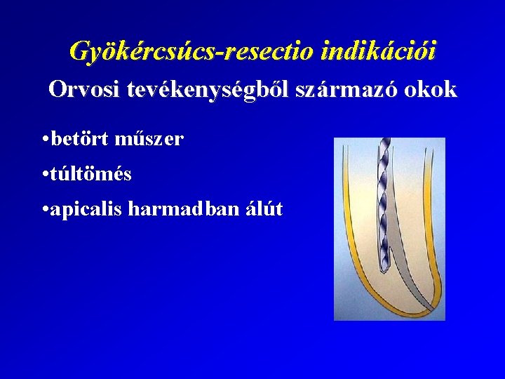 Gyökércsúcs-resectio indikációi Orvosi tevékenységből származó okok • betört műszer • túltömés • apicalis harmadban