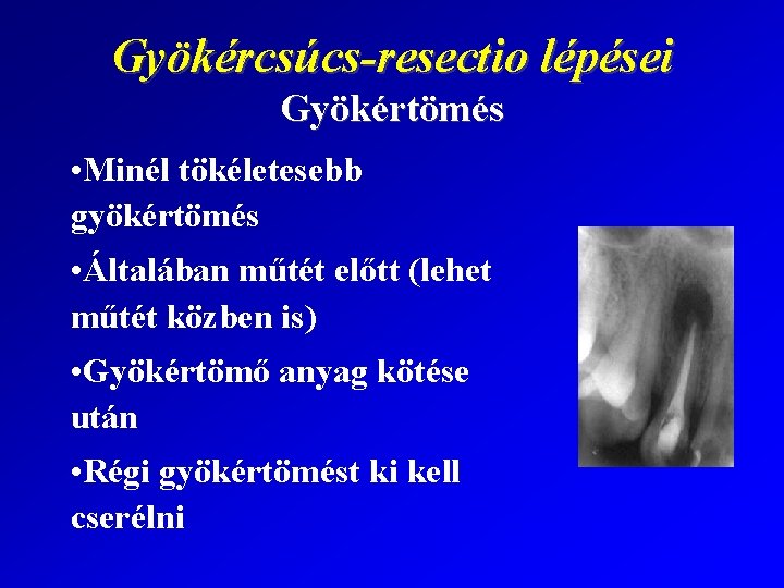 Gyökércsúcs-resectio lépései Gyökértömés • Minél tökéletesebb gyökértömés • Általában műtét előtt (lehet műtét közben