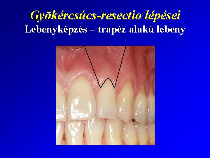 Gyökércsúcs-resectio lépései Lebenyképzés – trapéz alakú lebeny 