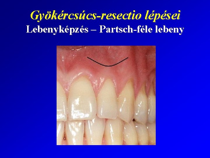 Gyökércsúcs-resectio lépései Lebenyképzés – Partsch-féle lebeny 