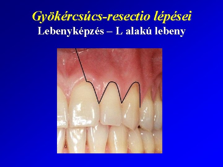 Gyökércsúcs-resectio lépései Lebenyképzés – L alakú lebeny 