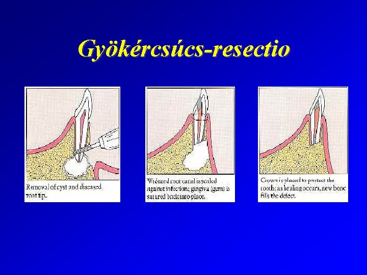 Gyökércsúcs-resectio 