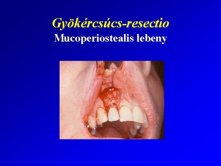 Gyökércsúcs-resectio Mucoperiostealis lebeny 