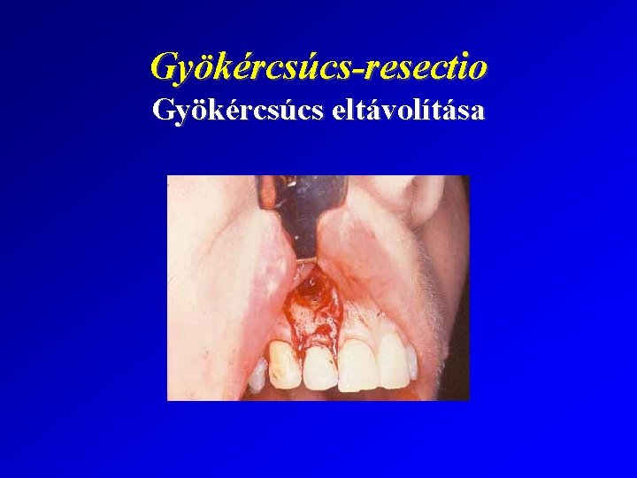 Gyökércsúcs-resectio Gyökércsúcs eltávolítása 