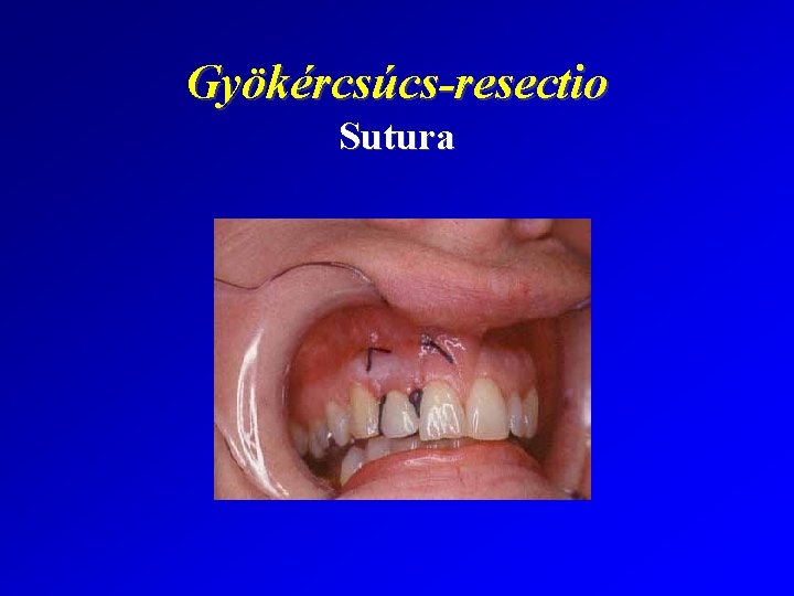 Gyökércsúcs-resectio Sutura 