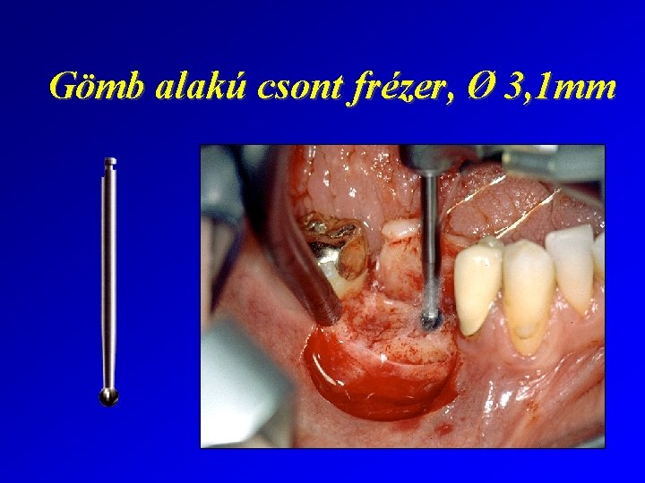 Gömb alakú csont frézer, Ø 3, 1 mm 