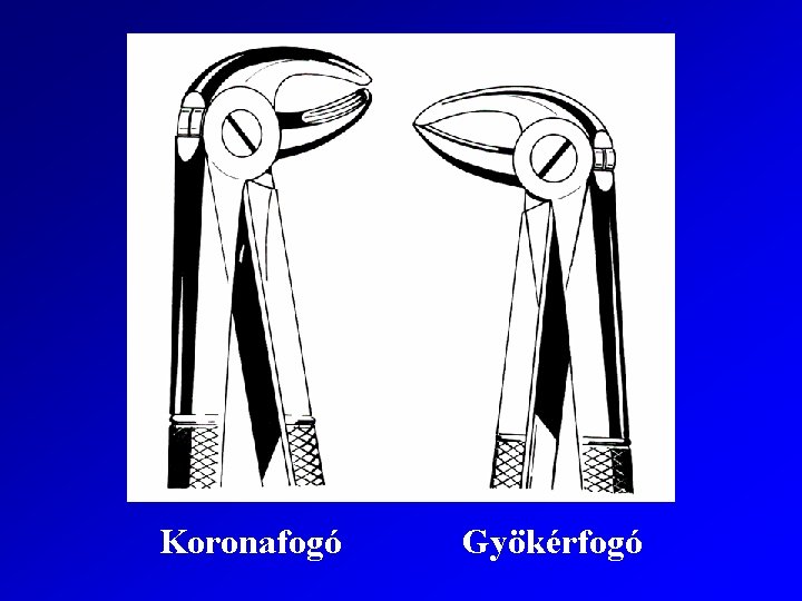 Koronafogó Gyökérfogó 