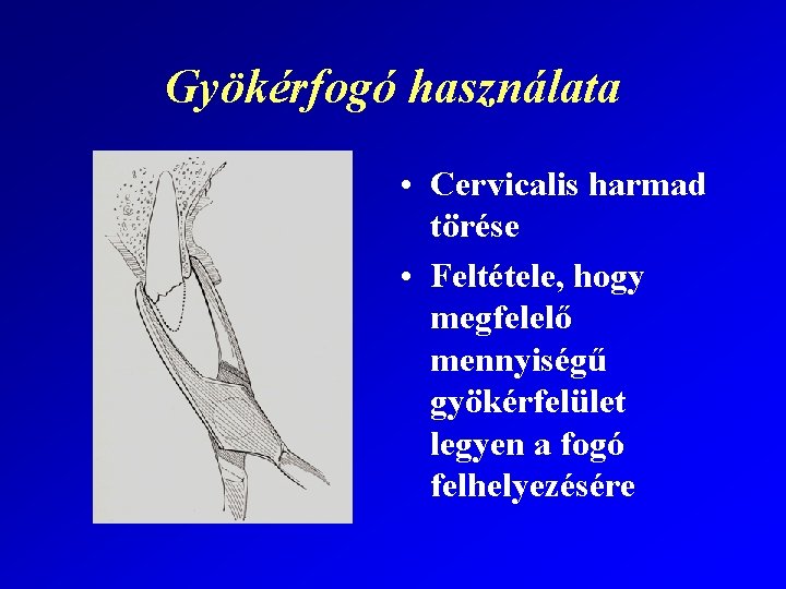 Gyökérfogó használata • Cervicalis harmad törése • Feltétele, hogy megfelelő mennyiségű gyökérfelület legyen a