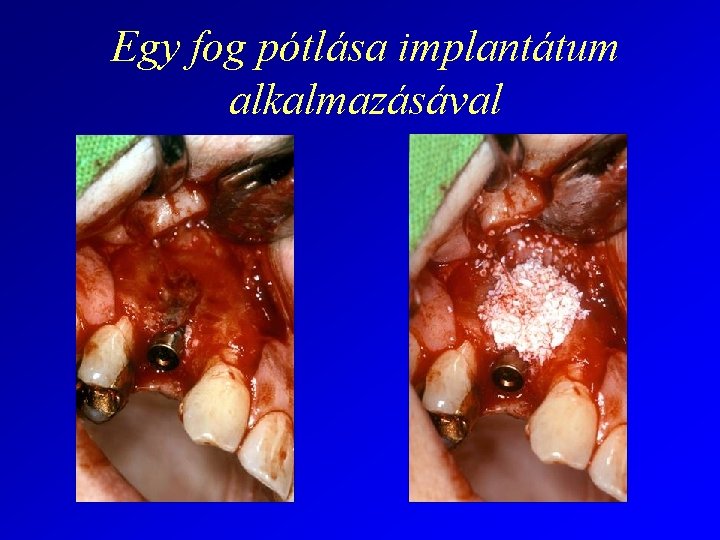 Egy fog pótlása implantátum alkalmazásával 