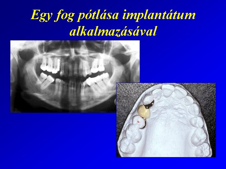 Egy fog pótlása implantátum alkalmazásával 