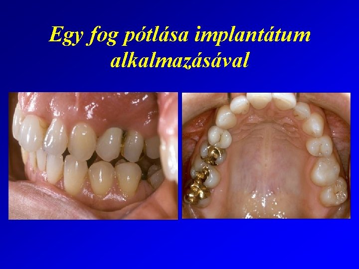 Egy fog pótlása implantátum alkalmazásával 