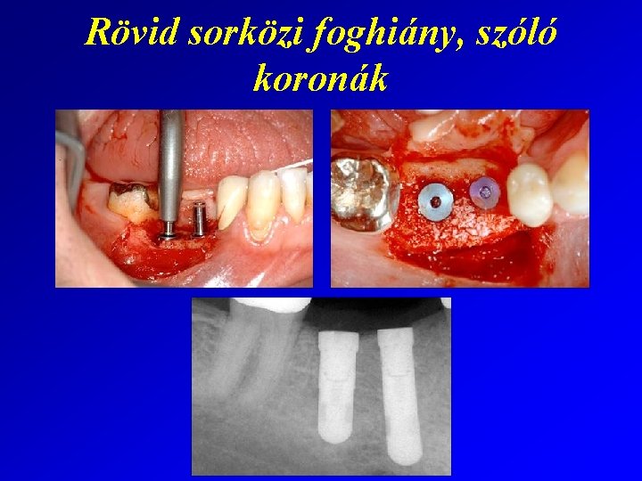 Rövid sorközi foghiány, szóló koronák 