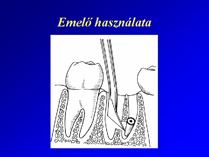 Emelő használata 