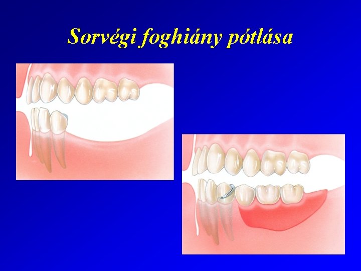 Sorvégi foghiány pótlása 