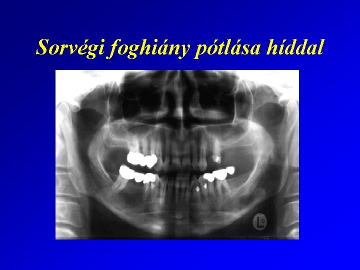 Sorvégi foghiány pótlása híddal 