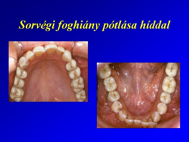 Sorvégi foghiány pótlása híddal 