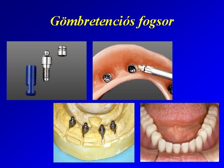 Gömbretenciós fogsor 