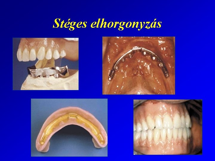 Stéges elhorgonyzás 