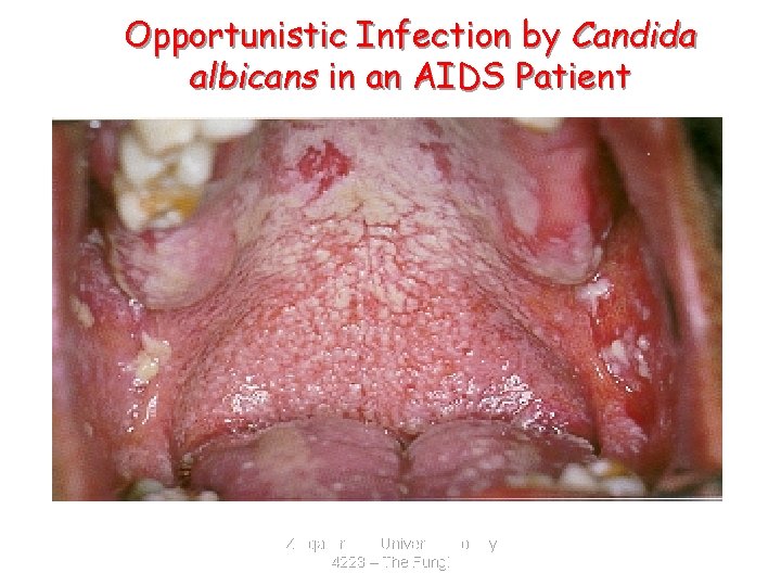 Opportunistic Infection by Candida albicans in an AIDS Patient Zarqa Private University. Biology 4223