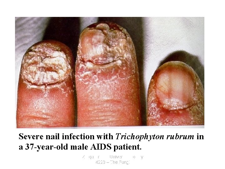 Severe nail infection with Trichophyton rubrum in a 37 -year-old male AIDS patient. Zarqa