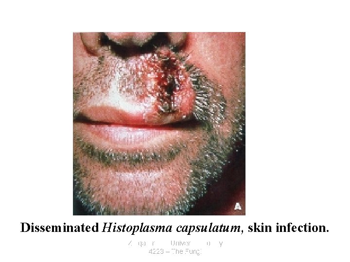 Disseminated Histoplasma capsulatum, skin infection. Zarqa Private University. Biology 4223 – The Fungi 