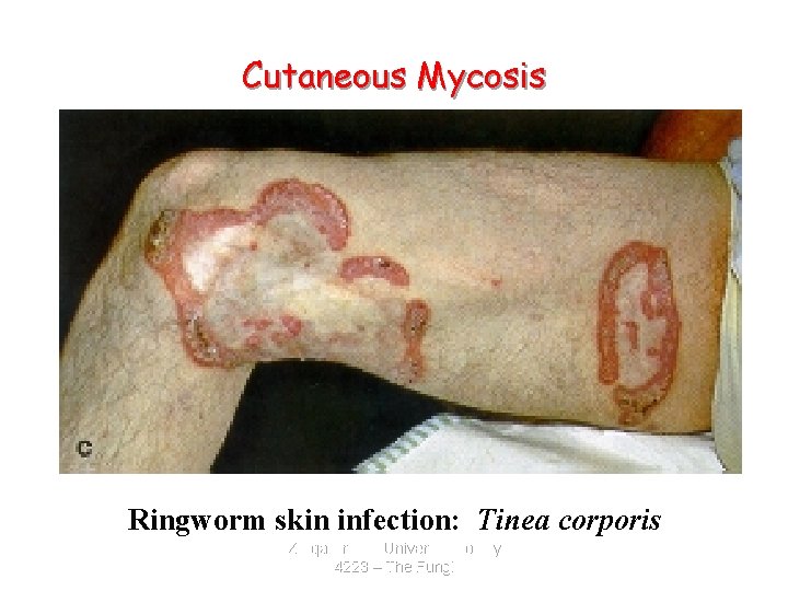 Cutaneous Mycosis Ringworm skin infection: Tinea corporis Zarqa Private University. Biology 4223 – The