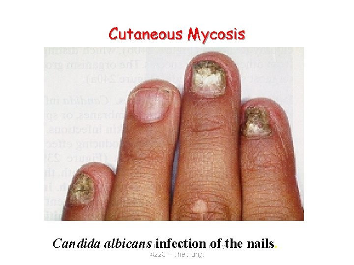 Cutaneous Mycosis Candida albicans infection of the nails. Zarqa Private University. Biology 4223 –