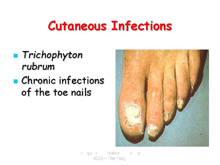 Cutaneous Infections n n Trichophyton rubrum Chronic infections of the toe nails Zarqa Private