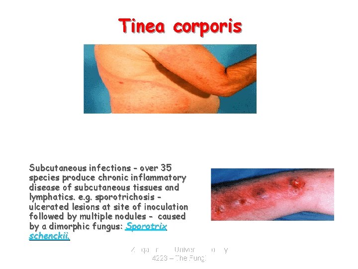 Tinea corporis Subcutaneous mycoses Subcutaneous infections - over 35 species produce chronic inflammatory disease