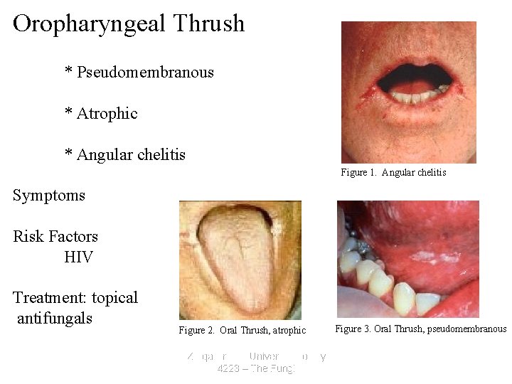 Oropharyngeal Thrush * Pseudomembranous * Atrophic * Angular chelitis Figure 1. Angular chelitis Symptoms