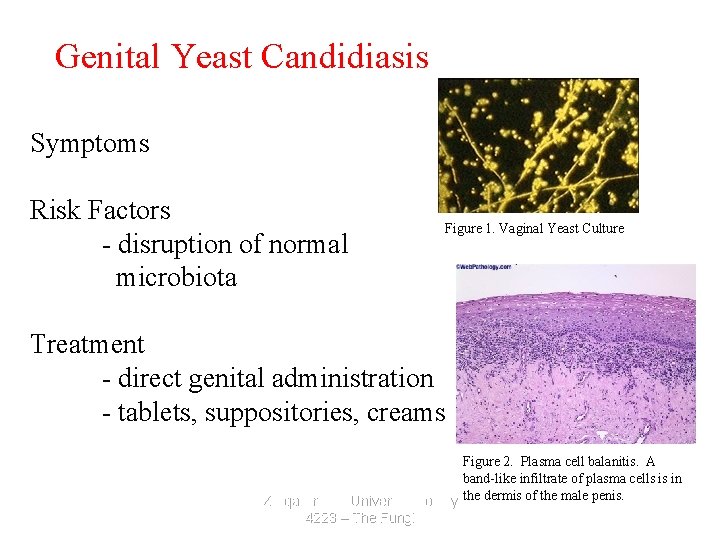 Genital Yeast Candidiasis Symptoms Risk Factors - disruption of normal microbiota Figure 1. Vaginal