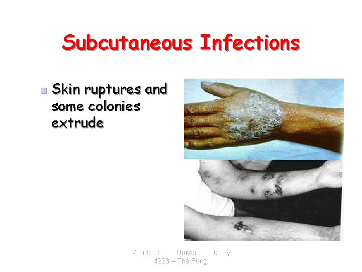 Subcutaneous Infections n Skin ruptures and some colonies extrude Zarqa Private University. Biology 4223