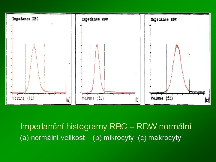 Impedanční histogramy RBC – RDW normální (a) normální velikost (b) mikrocyty (c) makrocyty 