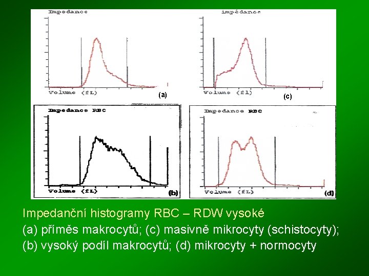 (a) (c) Impedanční histogramy RBC – RDW vysoké (a) příměs makrocytů; (c) masivně mikrocyty