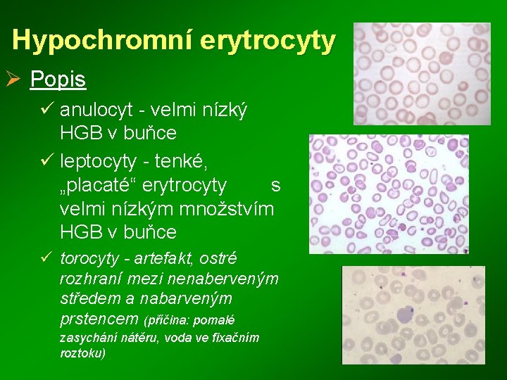 Hypochromní erytrocyty Ø Popis ü anulocyt - velmi nízký HGB v buňce ü leptocyty