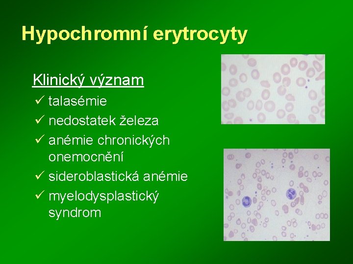 Hypochromní erytrocyty Klinický význam ü talasémie ü nedostatek železa ü anémie chronických onemocnění ü