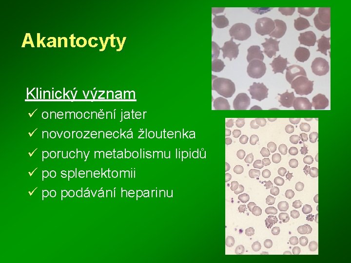 Akantocyty Klinický význam ü onemocnění jater ü novorozenecká žloutenka ü poruchy metabolismu lipidů ü