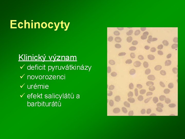 Echinocyty Klinický význam ü deficit pyruvátkinázy ü novorozenci ü urémie ü efekt salicylátů a