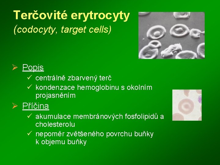 Terčovité erytrocyty (codocyty, target cells) Ø Popis ü centrálně zbarvený terč ü kondenzace hemoglobinu